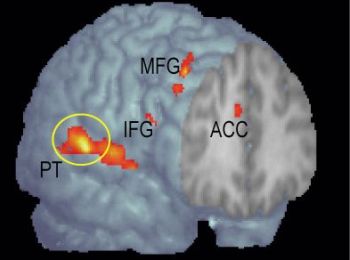 Illuminated areas in this brain image indicate activation related to perceptions of spatial change. The planum temporale region is marked with a yellow circle.